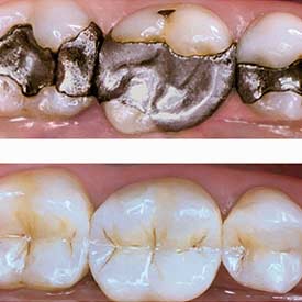 White Fillings