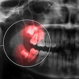 Tooth Extraction